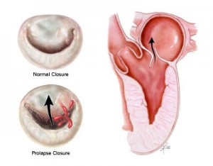 MitralValveProlapse pic