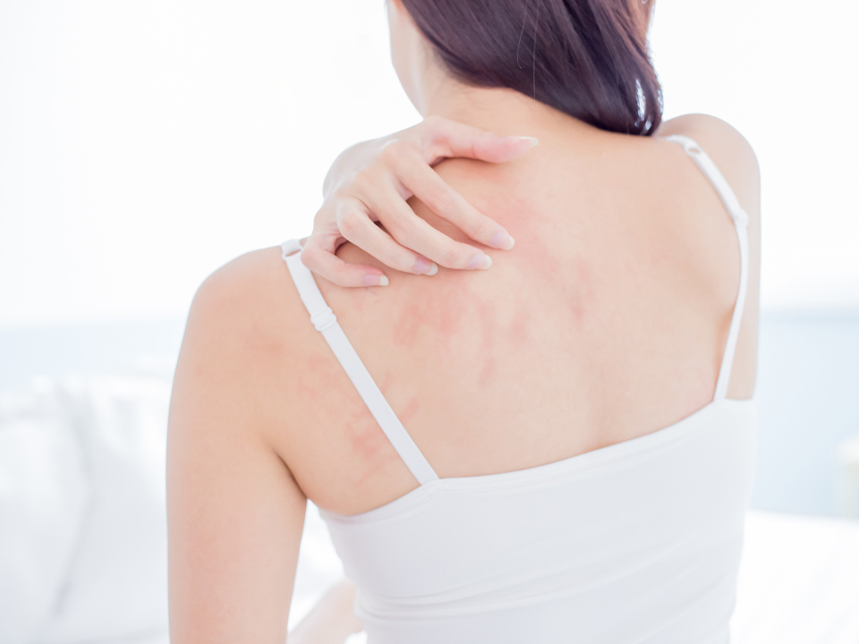 Understanding Eczema by Allison Smith, Office Manager