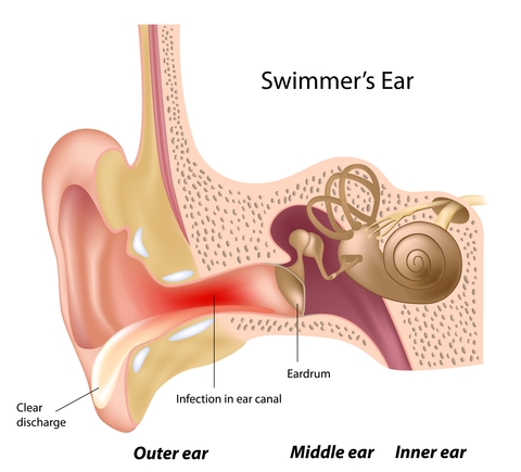 swimmers-ear-diagram