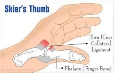 Skier's Thumb / Marque Urgent Care