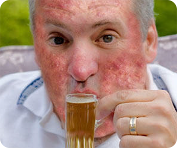 Can Drinking Alcohol Cause Acne?