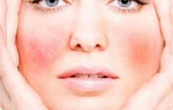 broken capillaries on the cheeks of a woman's face