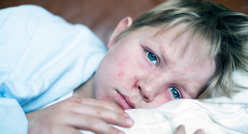 Pediatric patient showing possible measles signs and symptoms of measles