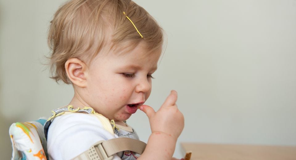 A child appearing to have contracted hand, foot, mouth disease.